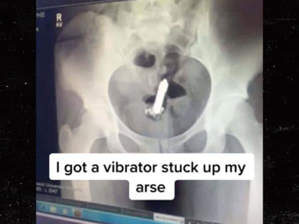 TikToker undergoes surgery to remove vibrator from her anus