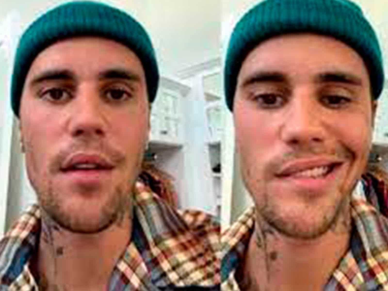 Justin Bieber revela que sufre parálisis facial